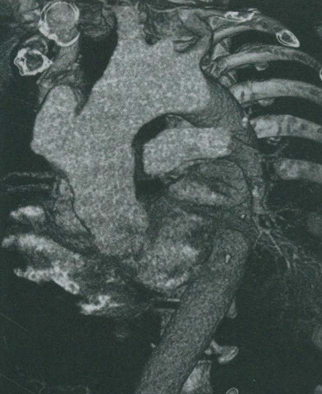 案例3:升主動(dòng)脈夾層腔內(nèi)治療